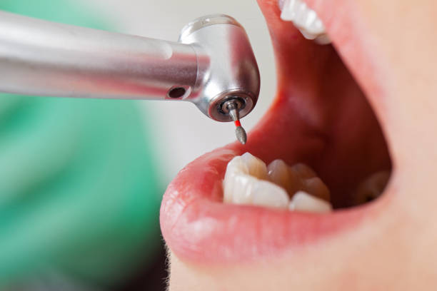 Best Emergency Dental Care for Broken or Chipped Teeth in Cheboygan, MI